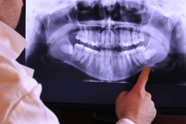 Best Knocked-Out Tooth (Avulsed Tooth) Treatment in Duncannon, PA